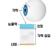 렌즈삽입술 부작용...각막내피세포 감소, 녹내장 발생 막으려면? [눈+사람]