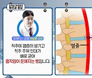 [주말엔 건강] 20~40대 남성의 '강직성 척추염'…조기 진단 중요