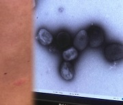주간 엠폭스 확진자 16명 늘어 누적 60명…남성이 96.6%