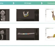 강북삼성병원, 구강암 환자 '턱 재건'에 3D 프린터 적용