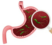 위암 발병 많은 한국인에 강력한 발암 인자