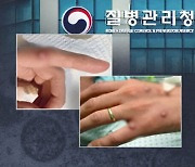 국내 엠폭스 경보 수준, 주의 단계 유지…예방 접종 확대