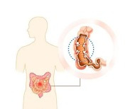 "크론병, 치료하면 정상생활 가능한 질환…편견 버려야"