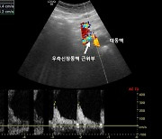 고혈압 약발 안 받는 이유? '이것' 때문일수도 [건강 팁]