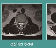 허리디스크·척추관 협착증의 차이? 허리 굽혀보면 안다