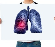 폐가 이유없이 딱딱해지는 '이 질환' 암보다 예후 불량