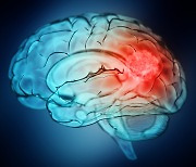 늘어나는 ‘뇌종양’ 환자…종양 위치와 크기 따라 증상 다양