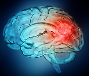 뇌압 상승은 ‘위험신호’…증세 다양한 뇌종양, 치료법도 다양