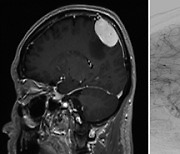 가장 흔하면서 치료 성공률도 높은 뇌종양, 뇌수막종 [장인석 원장의 뇌혈관 이야기]