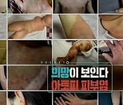 ‘생로병사의 비밀’ 아토피 피부염, 신약 개발로 치료 청신호