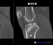 전방십자인대 수술했는데 또 파열? [한도환의 무릎 이야기]