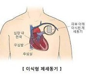 "제세동기 심은 환자, 우울증·불안장애 가능성"