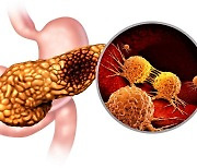 췌장암 수술 직후 ‘사망’ 초래하는 이 합병증…위험 줄이려면?