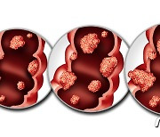 젊은 환자 대장암 더 독한데 생존율 높은 비결…나이 아닌 '항암치료'