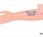 테니스엘보, 상황마다 치료 달라진다 [곽상호의 손·손목 이야기]