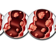 젊은 환자 '대장암' 더 독했다…생존율 높은 비결은 나이 아닌 이것