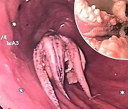 “식도에 문어가 통째로 끼었다”…CT 찍은 의사도 충격