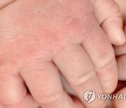 "아토피 정복"… JW중외·LG화학 게임체인저 될까