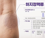 “여름이 두려운 하지정맥류”