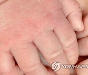 아토피 앓는 취약계층 어린이에 진료비 바우처 지원 추진