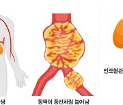 ‘배 속의 시한폭탄’ 복부 대동맥류…인조혈관 삽입술 대세