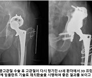 임플란트 인공고관절 수명 늘렸다…화순전남대병원팀 '성과'