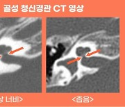 청신경 상태를 보면 인공와우 이식 결과 예측 가능