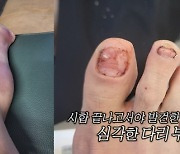 “종아리 근육 18㎝ 찢어져” 박선영, 부상 사진에 깜짝 (미우새)