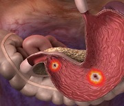 국민 30% 앓고 있는 '이 질환'… 방치하면 위암 돼