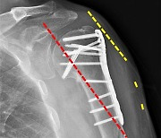 고령·골다공증 어깨 상완골 골절, 최소 절개 고정술 가능…합병증 '0'