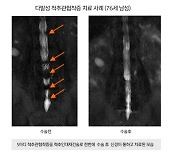 여러 부위 척추관협착증 한 번에 치료가 더 효과적 ['48년 척추명의' 이상호 박사의 명쾌한 척추 건강법]