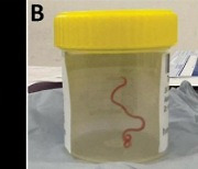 '의사도 충격' 건망증 앓던 여성 뇌에서 나온 8㎝ 기생 회충
