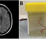 ‘헉! 뇌 속에서 8cm 벌레가 꿈틀’…건망증 앓던 여성 뇌에 비단뱀 기생회충