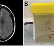 ‘건망증·우울증’ 60대 호주 여성, 뇌 속에 8㎝짜리 벌레 ‘꿈틀’