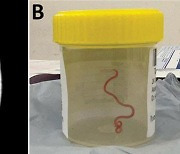 수술 받던 호주 여성, 뇌에서 살아있는 기생충 발견…“야생 동물과 접촉 증가 원인”
