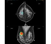 "전문의 못지않은 루닛AI 유방암 진단능력"…비교연구 국제저널 게재