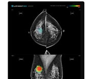 루닛 "루닛 인사이트 MMG, 유방암 진단능력 전문의만큼 우수"