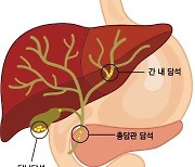 담낭·담관에 생긴 돌, 그냥 가지고 있어도 될까? [건강 나침반] 