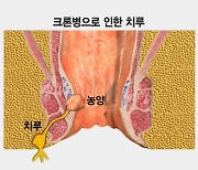 ‘생로병사의 비밀’ 계속되는 설사와 복통, 혹시 ‘크론병’?