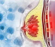 유방암 70% 차지하는 '호르몬 수용체 양성 유방암', '이 치료' 병행하니 재발률 감소