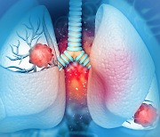 4년 새 27% 증가한 폐암 환자...폐암은 조기 진단이 가능할까? [건강톡톡]