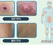 남원시 “쯔쯔가무시증 주의하세요…10~11월에 집중”