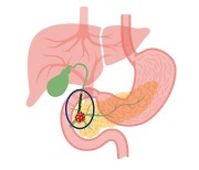 췌장암, 80대 고령환자도 수술 가능..재원기간·합병증·생존율 차이 없어