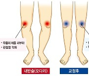 관절염 유발하는 오다리, 교정술 필요할까