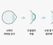 나에게 맞는 ‘드림렌즈’ 찾으려면…꼭 필요한 검사∙과정은? [눈+사람]