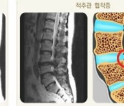 ‘꼬부랑 노인’ 척추관협착증, 조기 치료 ‘허리 업’