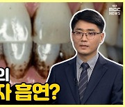 [약손+] 치주질환 치료와 예방 ②흡연과 치주질환