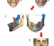 3D 이미지-가상수술 기반 환자 맞춤형 안면골 골절 수술법 개발