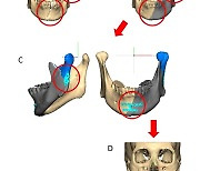 한림대성심병원, 3D 이미지·가상수술 기반 환자 맞춤형 안면골 골절 수술법 개발