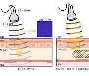 초음파, 간경화·폐섬유화까지 정확하게 진단한다